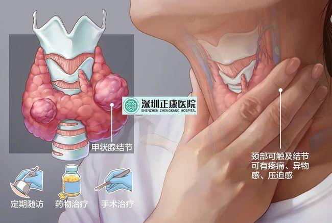 专家讲堂甲状腺结节的主要症状