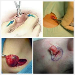 (皮脂腺囊肿 手术示意图)