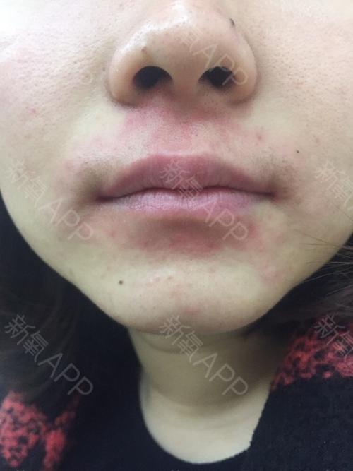 脱唇毛项目术后第0天 第一次尝试激光脱唇毛,还是有点疼,可能自己
