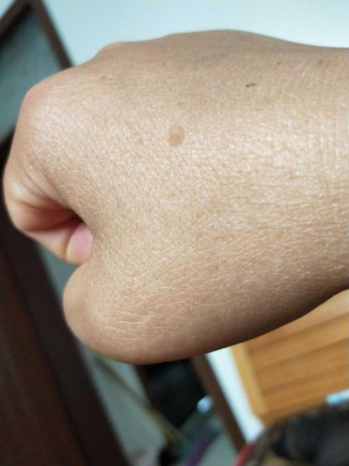 看看是扁平疣还是老年斑