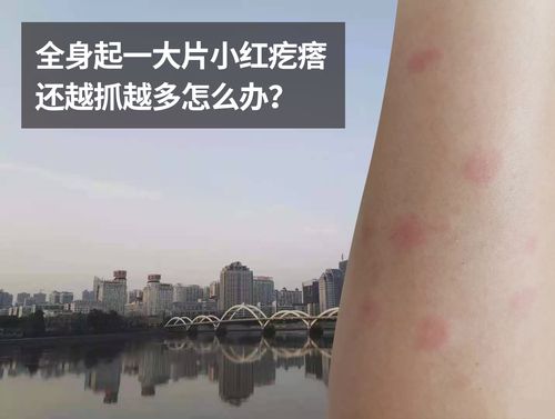 当我们身上有起这种成片的疙瘩,而且越来越多的话,多数是过敏引起的.