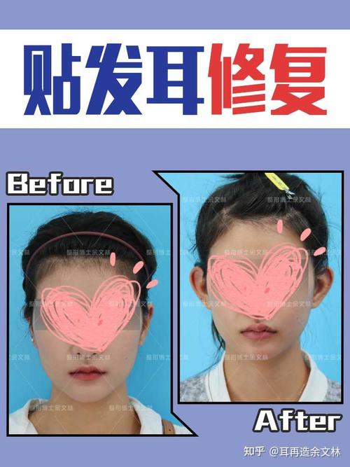 耳朵小双耳贴脑怎么改善63