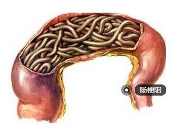 宝宝肠梗阻有什么症状有哪些