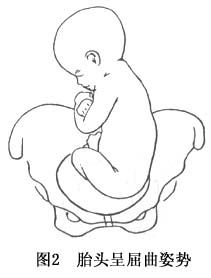 分为骶左前,骶左横,骶左后,骶右前,骶右横,骶右后6种胎方位