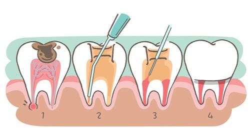 根管治疗后别忘了给牙齿带上安全帽