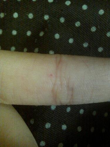 手上不知道为什么会有红点点,也不疼,几年前就开始有的