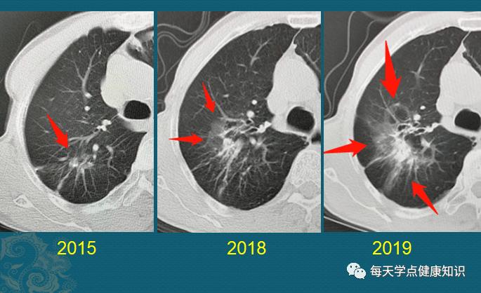 肺部孤立性病灶,直径>3cm的叫肿块(团块),直径介于1-3cm的叫结节,而