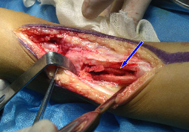 骨髓炎手术费用多少钱才可以呢