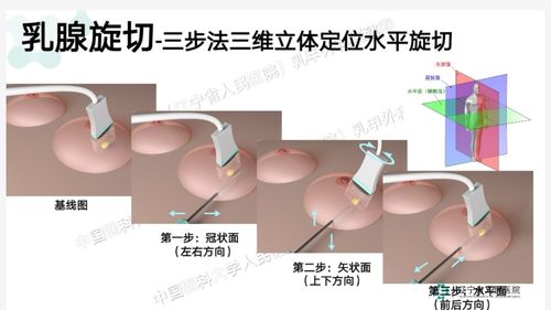乳管镜和乳腺旋切挑战早期乳腺癌传统模式的保乳手术