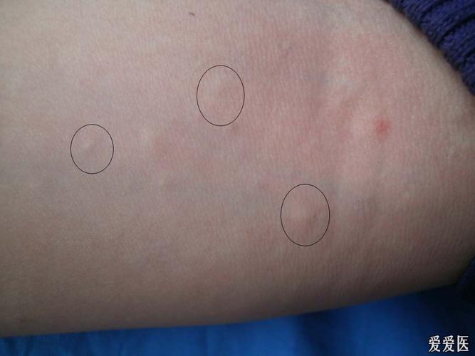 典型病例欣赏:多发性脂囊瘤.