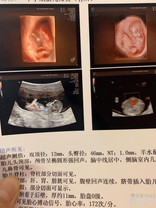 今天11周了去做nt了,请大家看看是男是