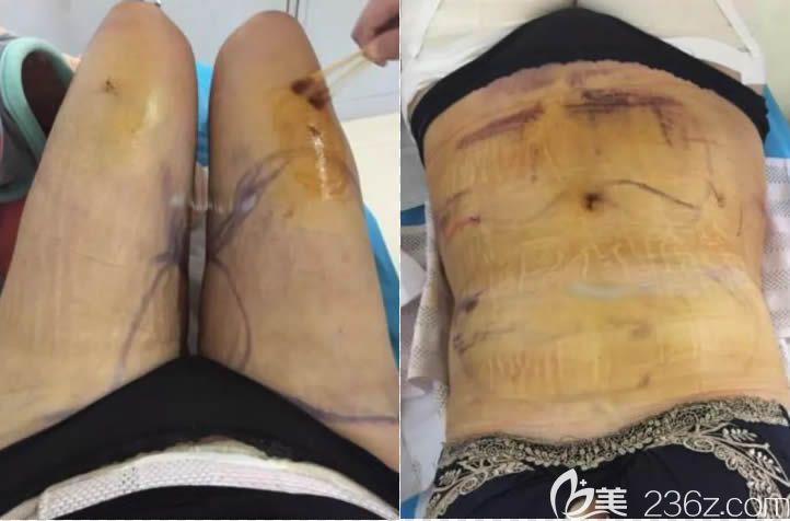 详述我让福州美贝尔赵栋材医生做大腿腰腹吸脂的亲身经历及感受真不