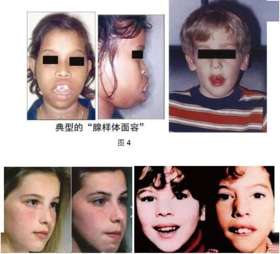 腺样体面容是什么?