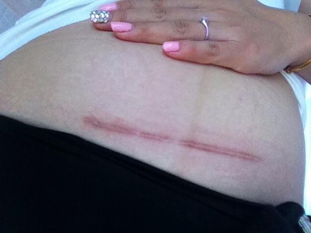 女性剖腹产并不轻松,会落下一些"后遗症",一个没中真