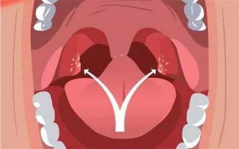 扁桃体发炎到底要不要用