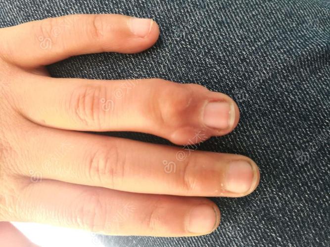 六岁儿童手指多发硬性结节请教诊断