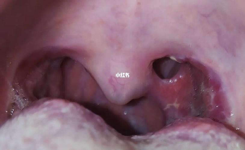 扁桃体切除手术后腭垂与创面粘连!