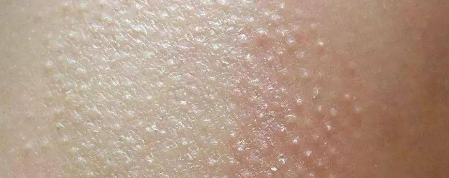 其实,「鸡皮肤」的出现主要和遗传有关,专业上叫「毛周角化症」.什么?