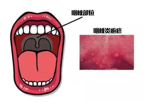 【卫生保健】疱疹性咽峡炎小知识