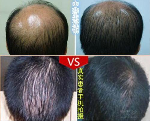 瑶元堂中药防脱发生发液增发密发止脱育发脂溢性洗发掉发头.