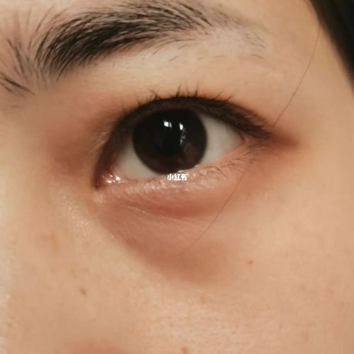 救命!这是什么类型黑眼圈!救命啊_黑眼圈_去黑