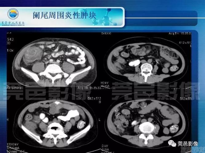 急性阑尾炎的ct表现