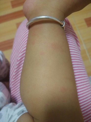 [图]宝宝皮肤过敏要紧吗?