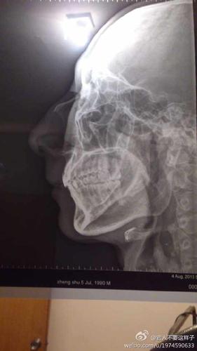 x12727:这样子鼻骨复位算成功了吗?