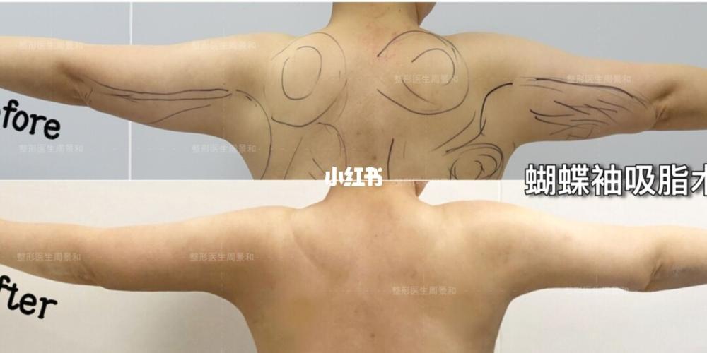 背部吸脂和蝴蝶袖吸脂案例分享_吸脂_减肥_运动_吸脂的话题_减肥_减肥
