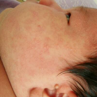 还是胎毒?用擦药吗?宝宝二十多天了.宝妈们帮忙看看