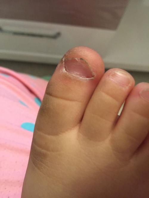 宝宝的脚指甲长这样,是缺什么吗?