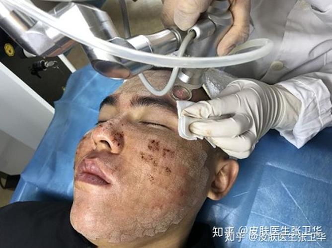 你们脸上的痘坑和痘印是怎么去掉的?
