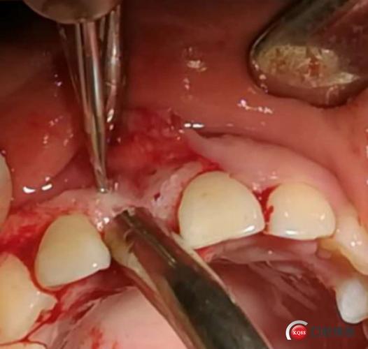 唇侧用球钻开孔,去骨皮质化,为骨替代材料提供血供来源.