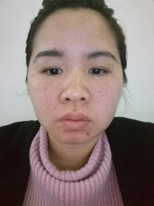 我因为个人贪吃,吃了一个芒果,嘴巴边上还有脸上过敏