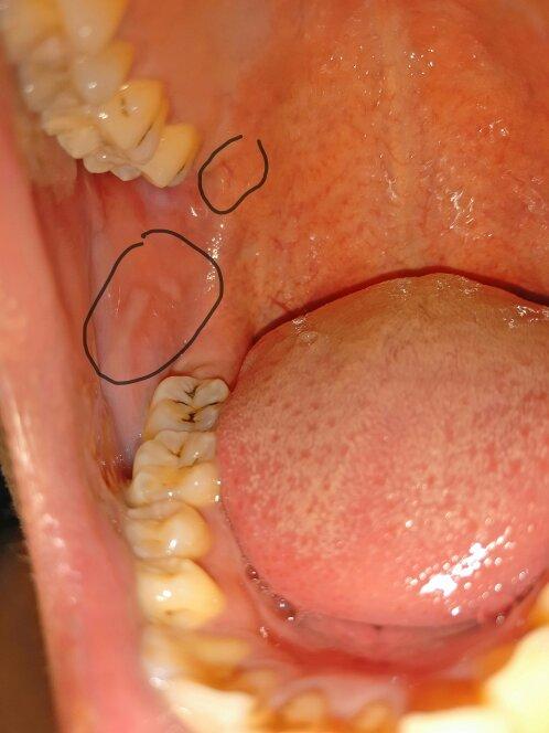 口腔内有时候长小疙瘩,嘴唇是疱疹还皮脂腺异位症