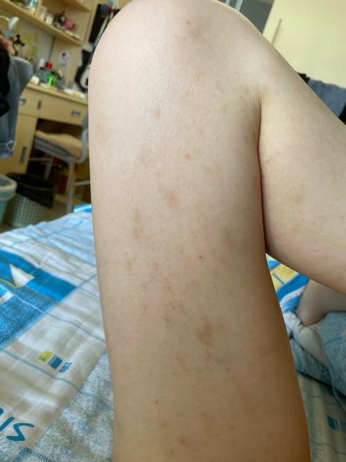 记录一下玫瑰糠疹的痊愈记录