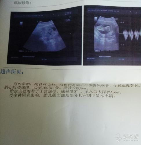 三个月的b超单,能看出男孩女孩吗