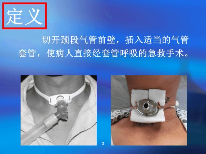 《气管切开术》ppt课件