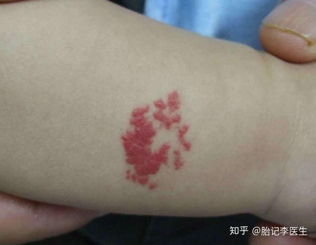 3.毛细血管瘤