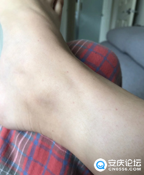 最近脚踝上出现了很多小红点,百度竟然说是艾滋病?心里很慌啊