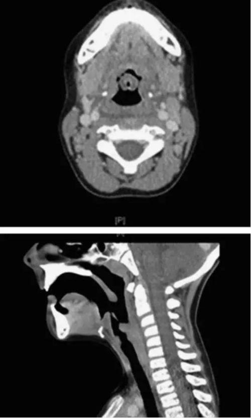 ct(轴位结合矢状位)显示会厌和杓会厌皱襞弥漫水肿和软组织肿胀