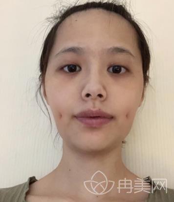 人造酒窝失败案例图片记录,术后感觉自己阔耐多了