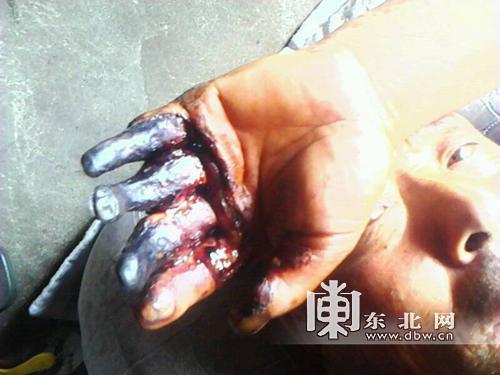 被电击的老人手部的骨头已裸露在外.李文昌提供
