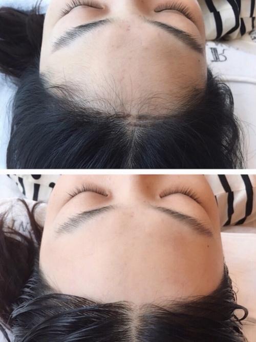 99【激光脱毛】脱发际线,抬发际线75159015