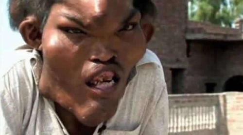 近亲结婚,人类的悲哀,看看这些可怜的孩子