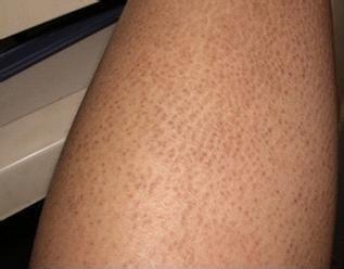 蛇皮肤怎么消除