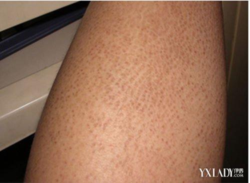 【图】鱼鳞皮肤病能治好吗? 几个方法教你如何改善鱼鳞病