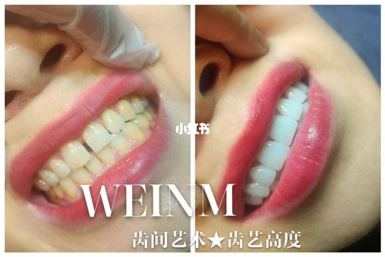 牙缝填充_牙齿美白_美牙_美白牙齿_美妆_医美整形