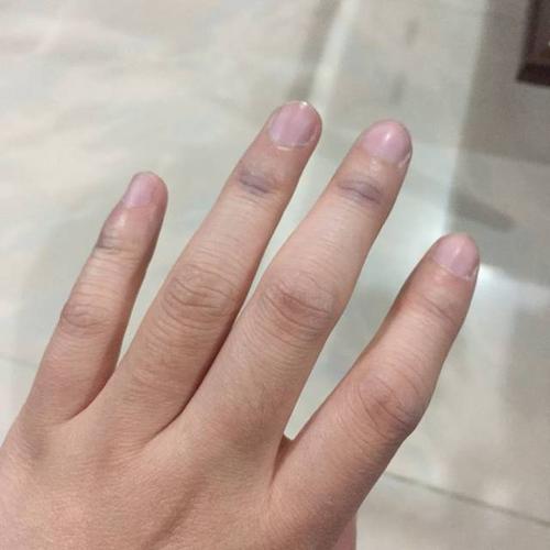 手指关节发黑_手背关节发黑