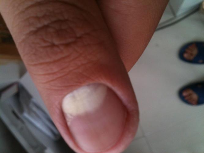 这个指甲月牙的地方发白,而且越来越多.怎么回事